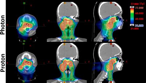 Proton And Photon Treatment Plans The Top Three Panels Show An Axial Download Scientific