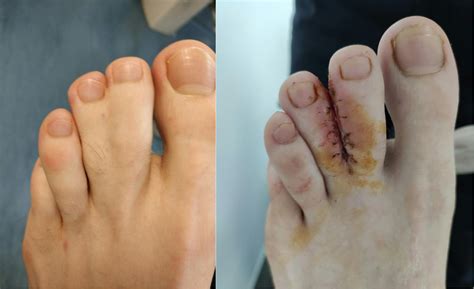 Syndactyly Webbed Toes Foot And Podiatry Surgery