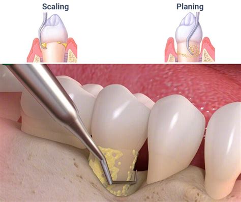 Deep Teeth Cleaning