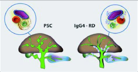 Difference between primary sclerosing cholangitis and IgG4-related ...