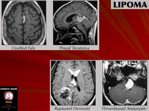 ГМ. Липома. + | Портал радиологов