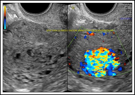 Uterine Arteriovenous Malformation Journal Of Obstetrics And