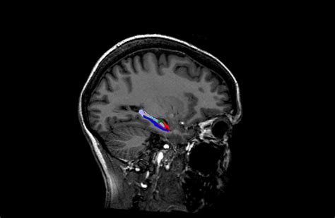 Sex Differences Found In Memory Region Of The Brain Queensland Brain