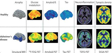 The Accuracy Of FDG PET Scans In Dementia Diagnosis