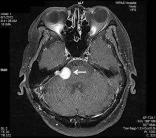 Neurinoma Acustico