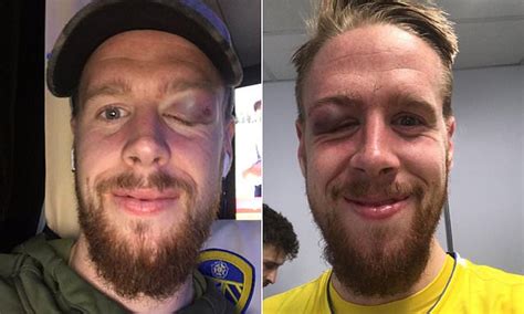 Leeds Star Pontus Jansson Reveals Gruesome Eye Injury From Preston Win