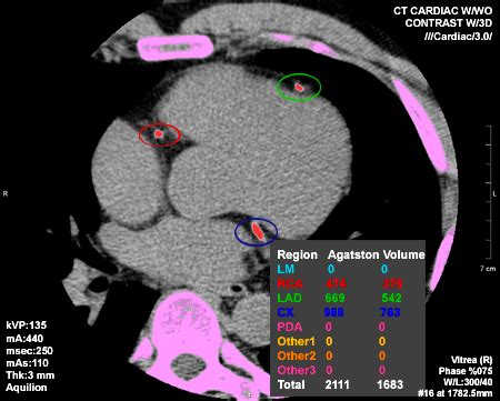 Calcium Scan Score Chart - Ponasa