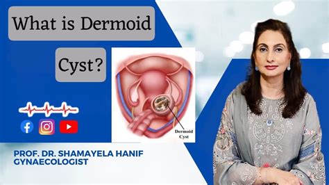 What Is Dermoid Cyst Treatment Causes Prof Dr Shamayela Hanif