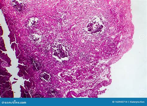 Bladder Cancer, Light Micrograph Stock Photo - Image of medicine, tumor ...