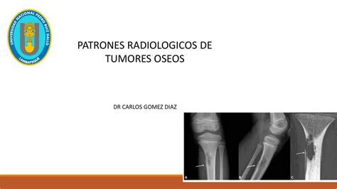 Patrones radiologicos de tumores óseos Shirley Luviana Bustamante