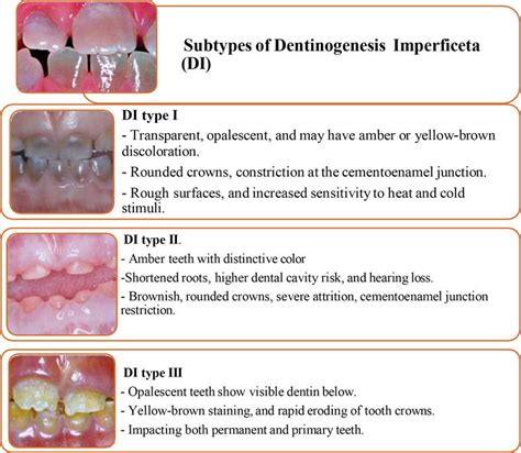 Hereditary Tooth Anomalies Amelogenesis Imperfecta Dentinogenesis