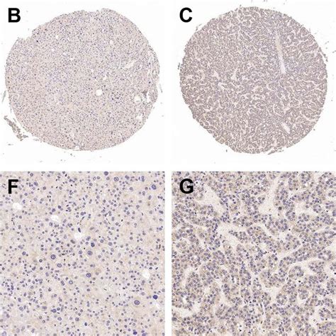 Immunohistochemical Staining Of Nrp Expression In Hcc Tissues With A