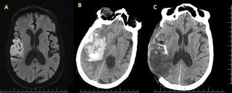 A Patient With Right Mca Infarction A Early Mri Findings B Download Scientific Diagram