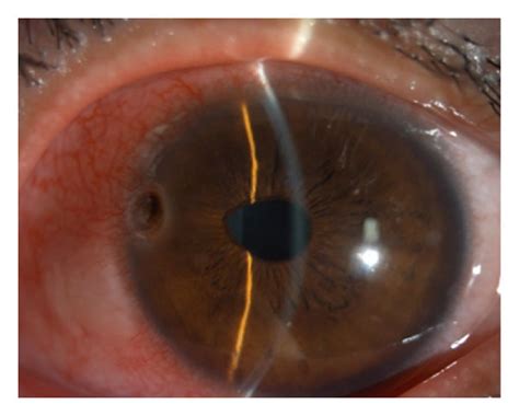 Penetrating Corneal Patching With A Conical Graft For Corneal