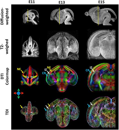 High Resolution Diffusion Weighted T2 Weighted Diffusion Tensor