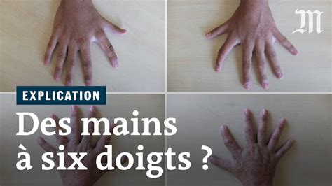 Six doigts à chaque main une étude se penche sur la polydactylie