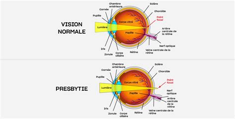 Presbytie diagnostic et traitement à Paris Centre Ophtalmologique COSS