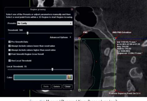 Figure 4 From Evaluation Of The Pharyngeal Airway Space Before And