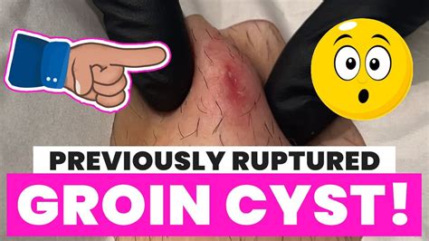 Previously Ruptured Groin Cyst Youtube