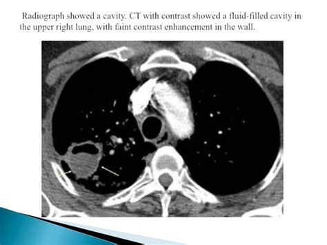 Differential diagnosis of cavitary lung lesions