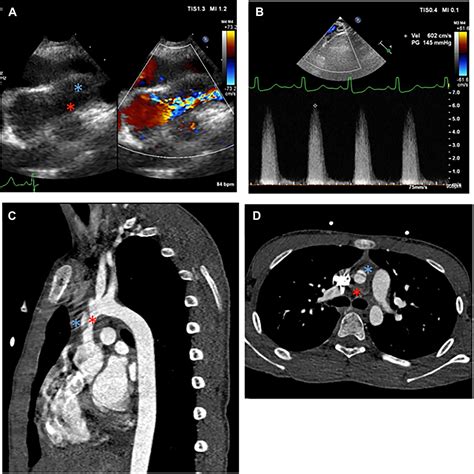 Aortic Dissection And Supravalvular Aortic Stenosis With Williams