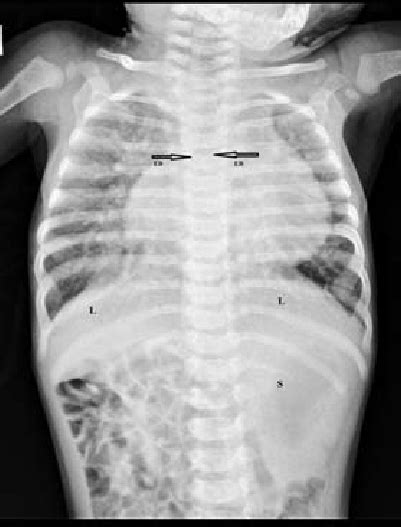 Chest And Abdomen X Ray Shows Bilateral Eparterial Bronchi Symmetrical