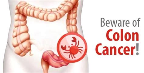 What Are The 7 Early Signs Of Colon Cancer ABTC