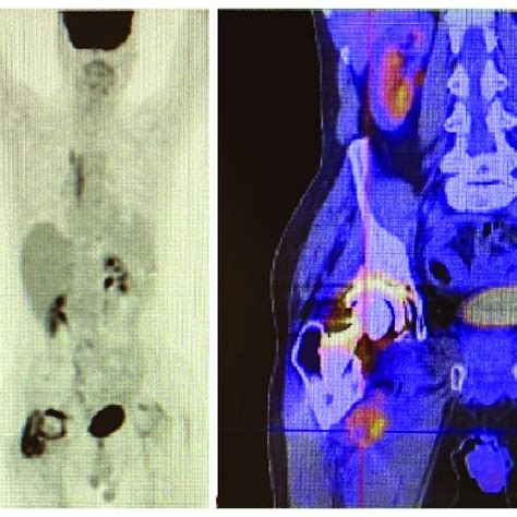 Positron Emission Tomography Computed Tomography Showing Increased