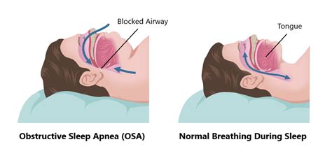 How Does Weight Affect Obstructive Sleep Apnea Osa Mechanism