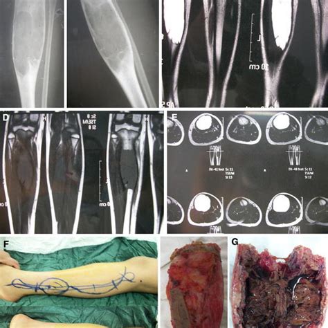 Operative Technique For Tumor Resection And Planning For Fibula