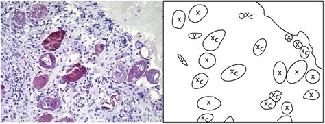 Histological Correlate To The Sandy Patch In Figure 9 Numerous