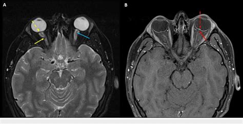 Magnetic Resonance Imaging Mri Of The Orbits With Gadolinium Contrast