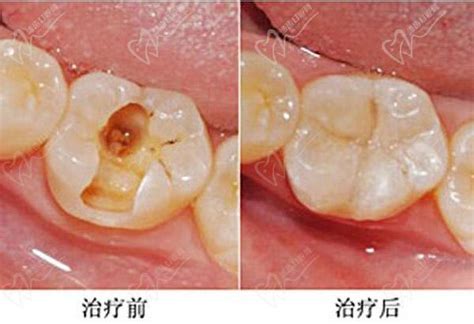 蛀牙初期图片查看，一文讲解有蛀牙怎么处理用什么牙膏好？皓齿口腔网