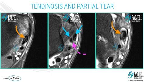 Posterior Tibial Tendon Tear Ankle