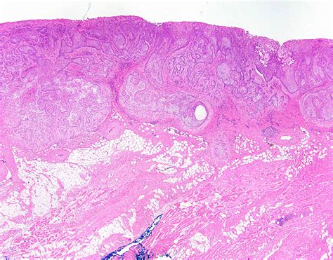 Basal Cell Carcinoma Under Microscope