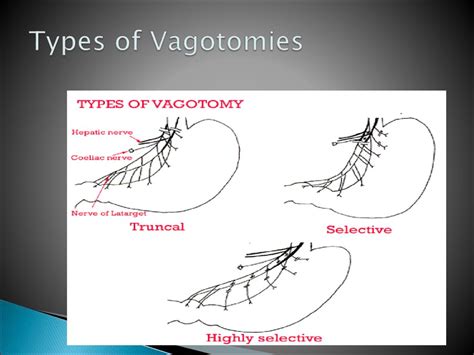 Types Of Vagotomy