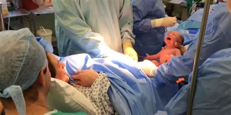 Natural C-Section Video - Baby Wiggles Out of Mom's Abdomen