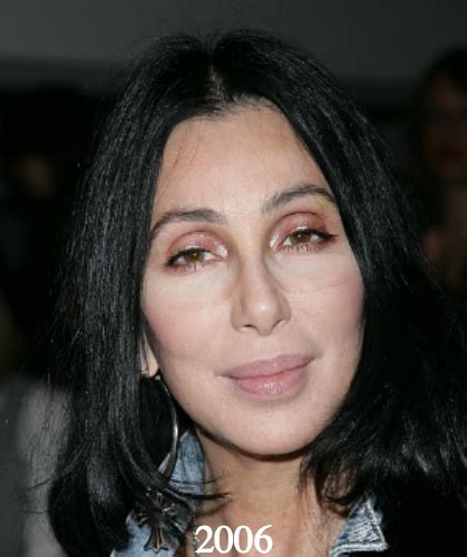 Cher Plastic Surgery Before and After Photos