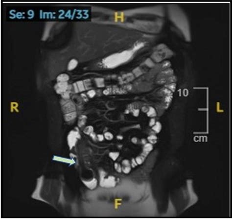 Inverted Meckel S Diverticulum A Case Report And Role Of Radiological