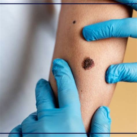 Passi Avanti Nella Cura Del Melanoma Presto Il Vaccino Giornale Di