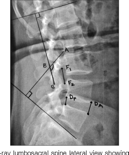 Figure 1 From Comparison Of The Early Results Of Transforaminal Lumbar Interbody Fusion And