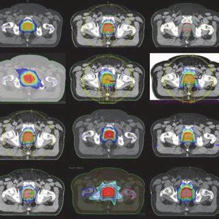 Dose Distribution In The Isocenter Axial Slice For Patient Number 1