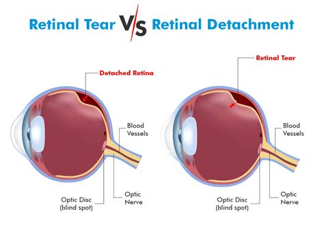 Retinal Tear Vs Retinal Detachment Find The Difference