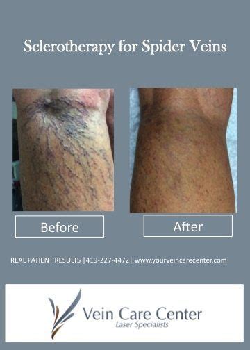 Spider Vein Treatment Before After Pictures Lima Auglaize County Oh Artofit