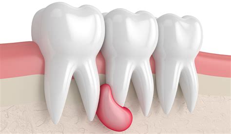 Abscess Tooth What Is Causes Symptoms And Treatment