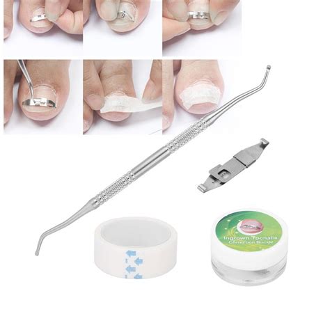 Mgaxyff 3pcs Ingrown Toenail Corrector Paronychia Treatment Nail ...