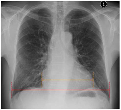 Enlarged Heart X Ray