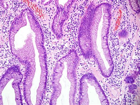 Flickriver Photoset Stomach Hyperplastic Polyp By Qiaos Pathology