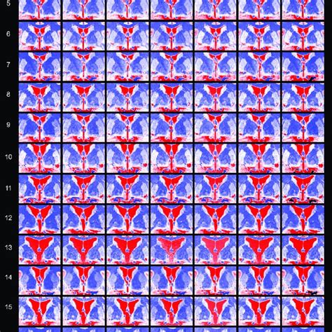 Inter Individual Intensity Variation Revealed By Colour Coding Coronal