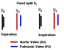 Fixed split S2 heart sound | Learn the Heart